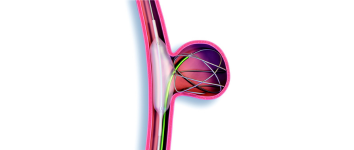 AVM Embolisation